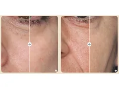 Silk´n FaceTite MultiPlatform skin rejuvenation device thumbnail 2