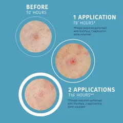 Iroha Patches for acne and skin imperfections SOS Pimple Patches 18 pcs thumbnail 3