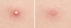 Mizon Good Bye Blemish Cleansing Patches (Clear Patch) 44 pcs thumbnail 6